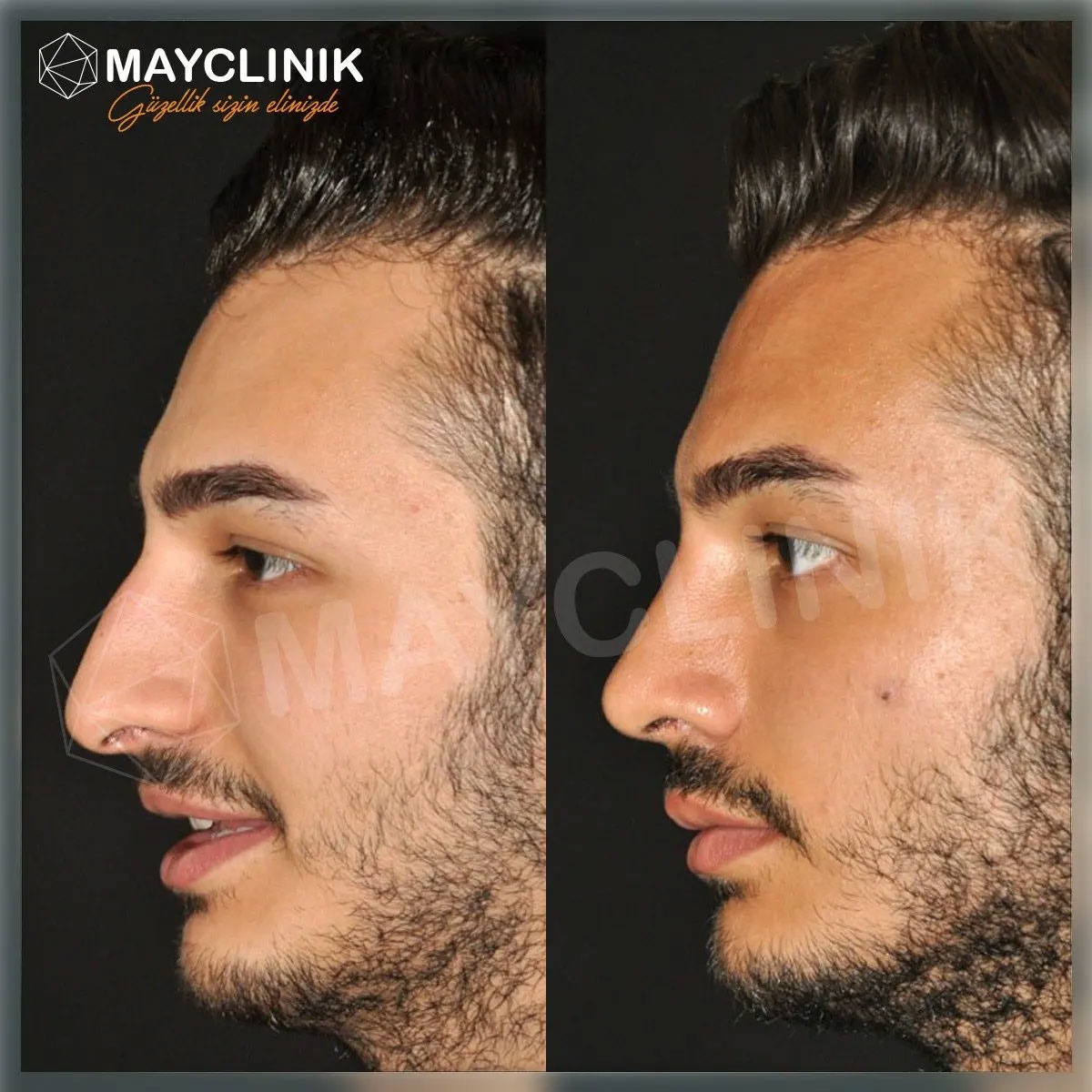 plastic surgeon rhinoplasty plastic surgeon rhinoplasty