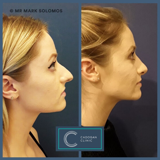 plastic surgeon rhinoplasty plastic surgeon rhinoplasty